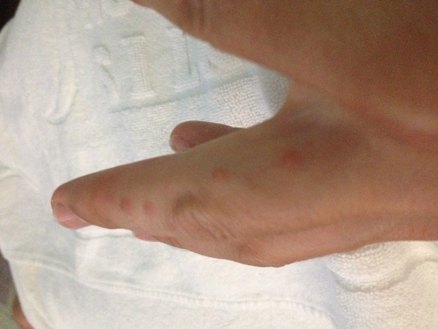 Bed Bug Bites On My Finger